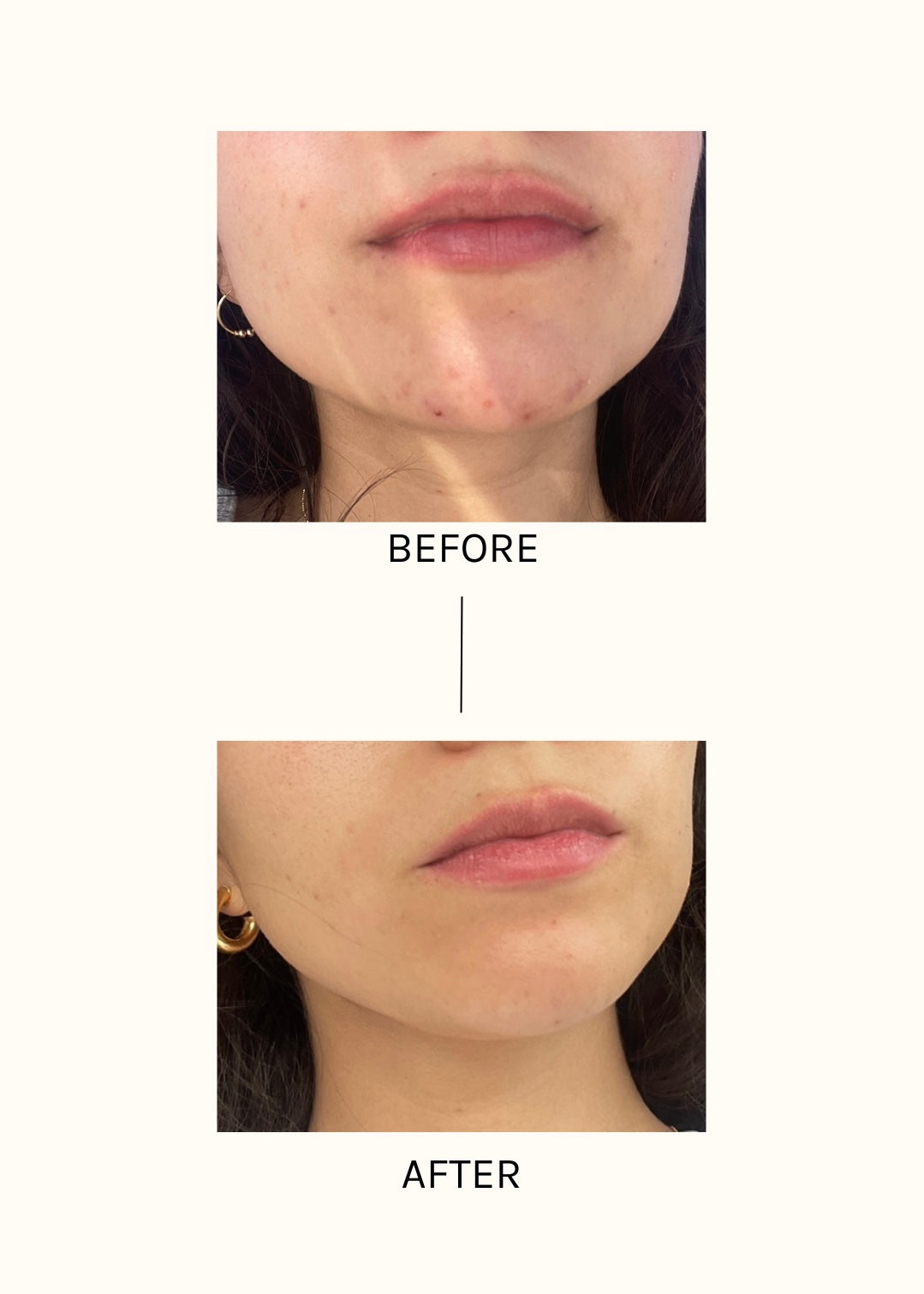 <br>Deep Chemical Peels
