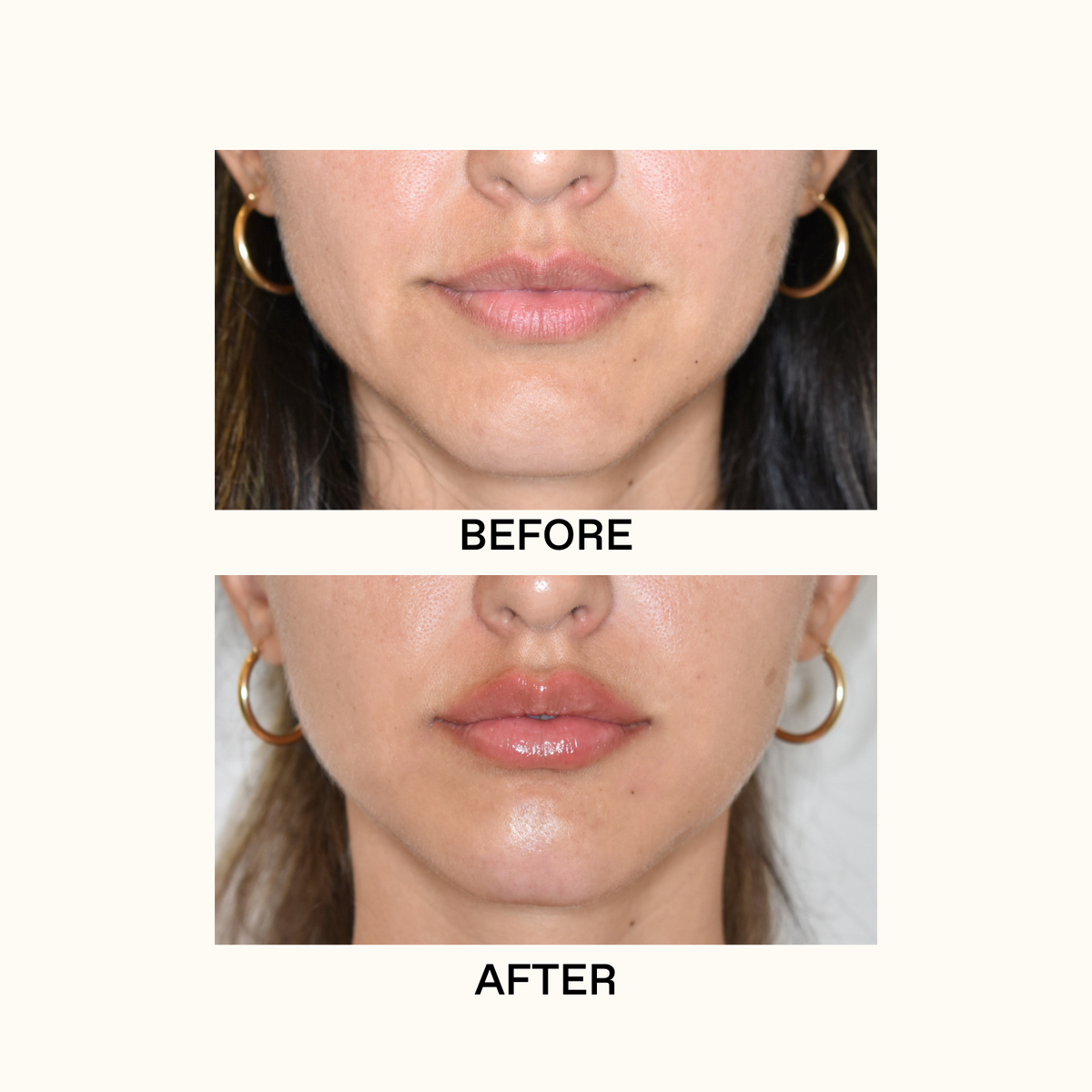 Lip Filler